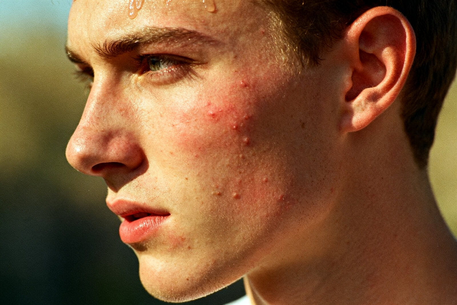Close-up of a man's jawline with mild-to-moderate inflammatory acne